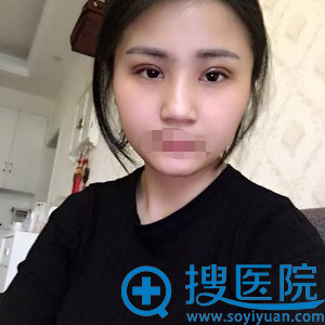 长沙美莱切开双眼皮拆线后效果 长沙美莱切开双眼皮拆线后效果