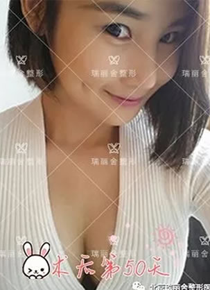 胸部怎么快速从A到D罩杯 北京瑞丽舍自体脂肪真人丰胸秘籍