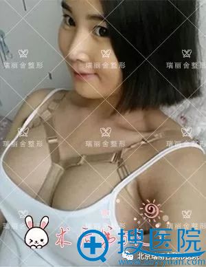 做完自体脂肪隆胸术第5天照片 做完自体脂肪隆胸术第5天照片