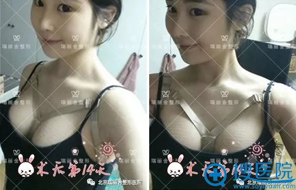 自体脂肪填充胸部第14天照片 自体脂肪填充胸部第14天照片