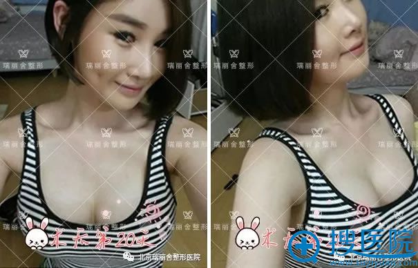 自体脂肪隆胸手术第20天 自体脂肪隆胸手术第20天
