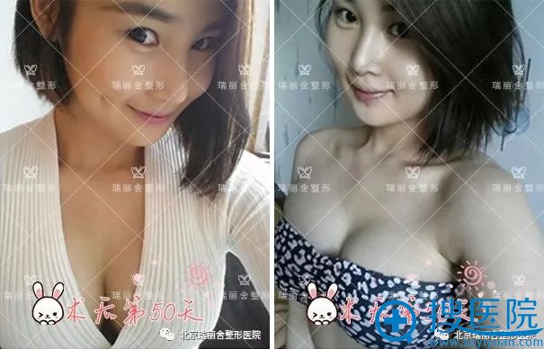 <!--<i data=20240710 data-id=12796></i>-->自体脂肪丰胸50天恢复照 <!--<i data=20240710 data-id=12796></i>-->自体脂肪丰胸50天恢复照