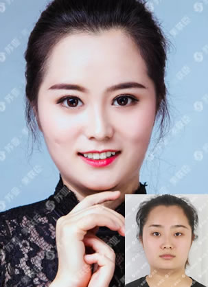 北京苏亚美联臣李燕做过的案例 护士员工摆脱单眼皮小眼睛过程