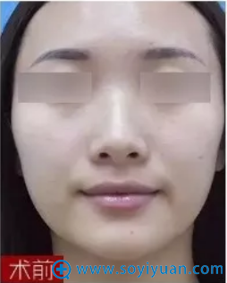 西安美好鼻部综合整形术前照 西安美好鼻部综合整形术前照