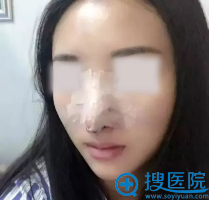 西安美好鼻综合手术术后1天照片 西安美好鼻综合手术术后1天照片