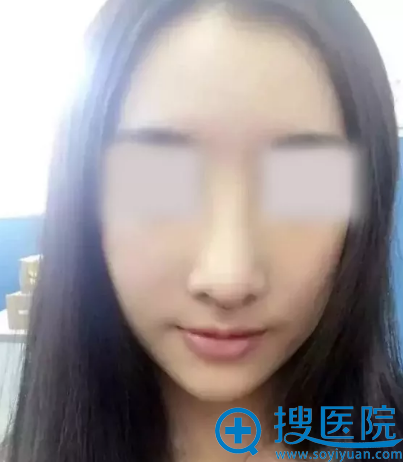 西安美好鼻综合手术拆线后效果 西安美好鼻综合手术拆线后效果