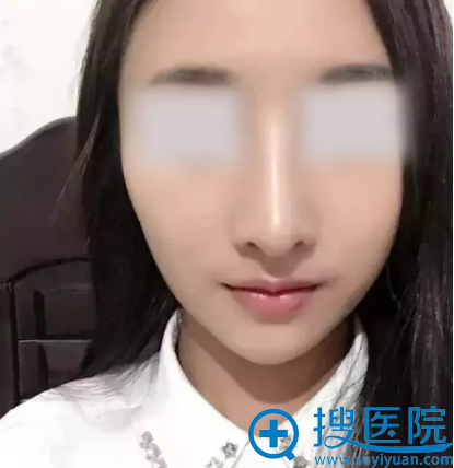 西安美好整形美容医院隆鼻手术9天 西安美好整形美容医院隆鼻手术9天