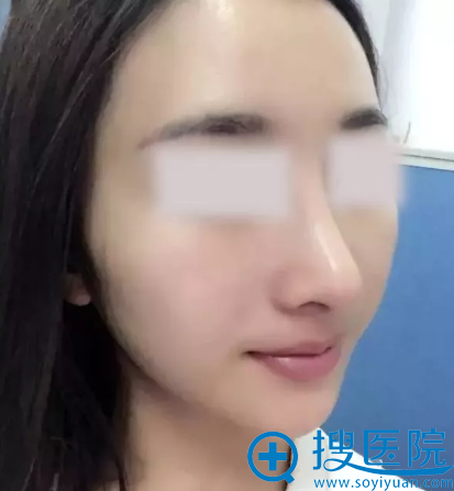鼻综合手术术后半个月恢复情况 鼻综合手术术后半个月恢复情况