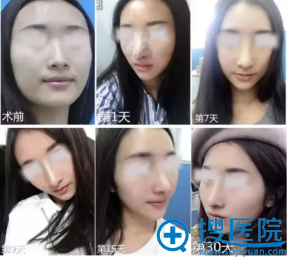 鼻综合术后一个月恢复全过程 鼻综合术后一个月恢复全过程