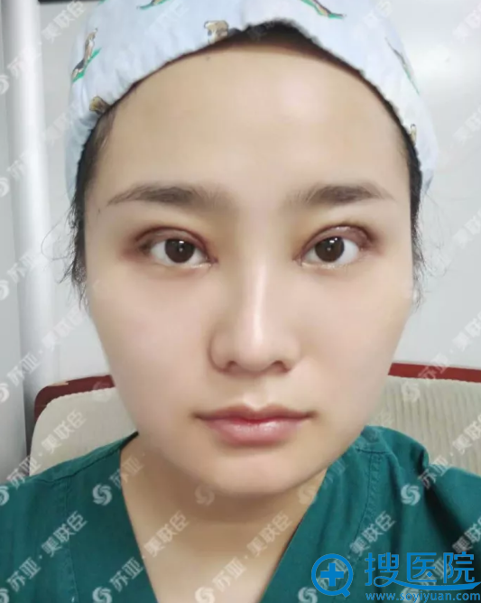 刚做完双眼皮手术的小斐 刚做完双眼皮手术的小斐
