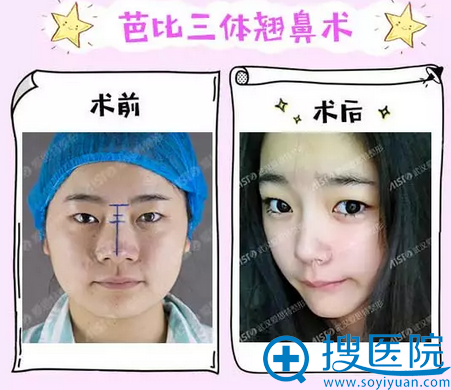 隆鼻前后对比图 隆鼻前后对比图