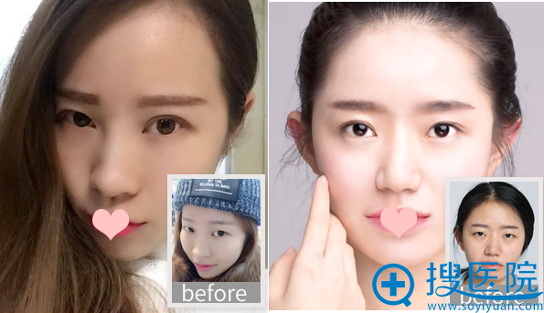 长沙雅美双眼皮案例 长沙雅美双眼皮案例