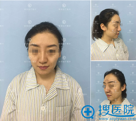 在哈尔滨索菲全脸脂肪填充已经1个月了,大家看术后效果自然吗