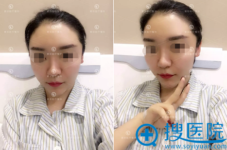 自体脂肪填充全脸术后即刻效果 自体脂肪填充全脸术后即刻效果