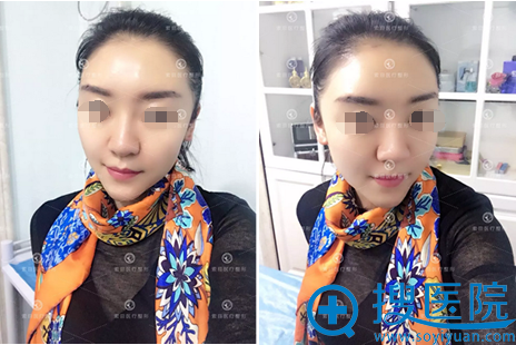脂肪填充苹果肌泪沟额头术后三天照片 脂肪填充苹果肌泪沟额头术后三天照片