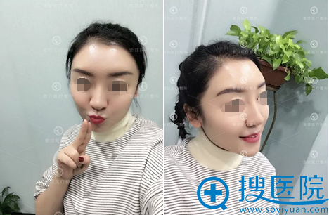 哈尔滨索菲脂肪填充全脸20天恢复照片 哈尔滨索菲脂肪填充全脸20天恢复照片