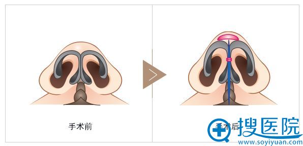 隆鼻手术示意图 隆鼻手术示意图