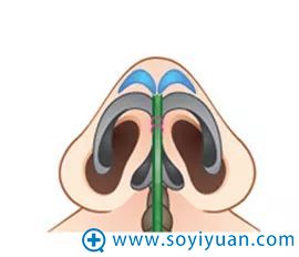 穹隆再造示意图 穹隆再造示意图