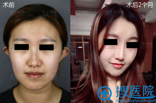 <!--<i data=20240710 data-id=12465></i>-->范荣杰鼻综合隆鼻案例 <!--<i data=20240710 data-id=12465></i>-->范荣杰鼻综合隆鼻案例