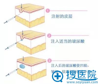 注射玻尿酸除皱效果示意图 注射玻尿酸除皱效果示意图