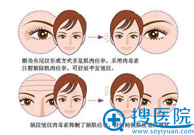 瘦脸除皱除皱效果示意图 瘦脸除皱除皱效果示意图