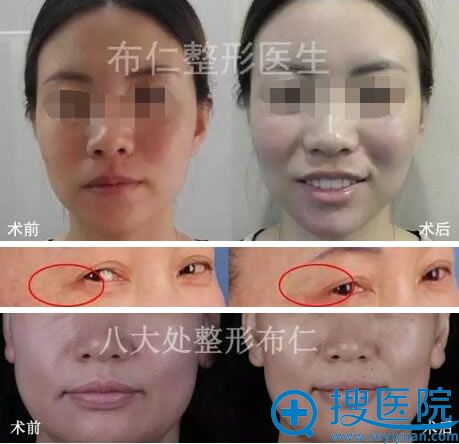 北京<!--<i data=20240710 data-id=1863></i>-->布仁注射瘦脸除皱案例 北京<!--<i data=20240710 data-id=1863></i>-->布仁注射瘦脸除皱案例