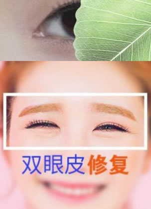 判断双眼皮失败的表现和修复方法科普篇,希望能帮到担忧的你