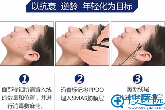 年前可以做的项目之面部线雕提升 年前可以做的项目之面部线雕提升