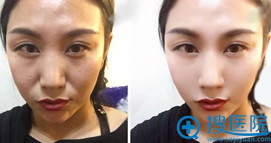 温州恒美面部线雕提升案例 温州恒美面部线雕提升案例