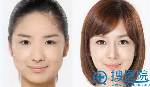 恒美瘦脸除皱真人案例 恒美瘦脸除皱真人案例