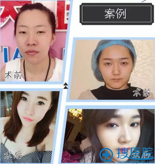 韩式埋线双眼皮手术适合学生做 韩式埋线双眼皮手术适合学生做
