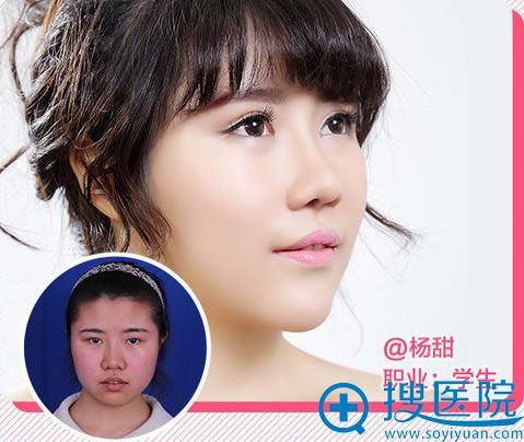学生隆鼻手术真人案例 学生隆鼻手术真人案例