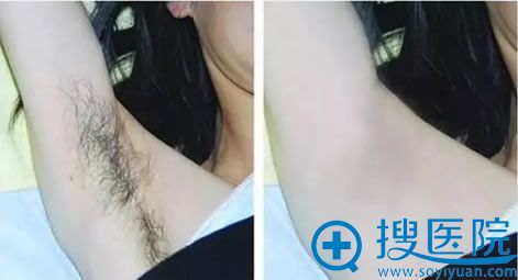 寒假学生脱毛手术案例 寒假学生脱毛手术案例