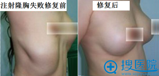 注射隆胸失败修复前后对比效果 注射隆胸失败修复前后对比效果