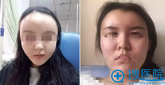 脂肪填充出现吸收过快、肿胀不平是什么原因?富华医生告诉你