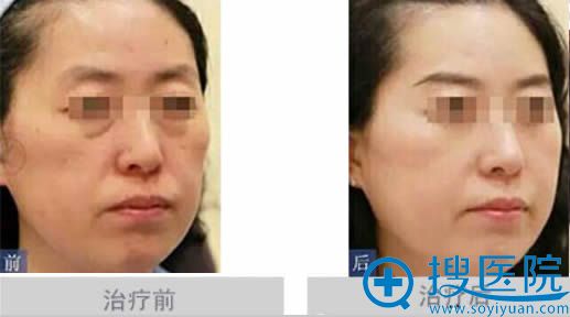 注射前后对比效果 注射前后对比效果