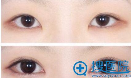 成功的双眼皮案例效果图 成功的双眼皮案例效果图