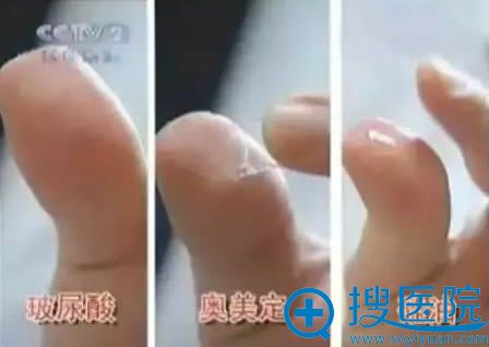 奥美定和玻尿酸的质感不同 奥美定和玻尿酸的质感不同