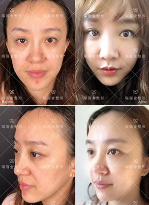 脸颊凹陷怎么能变圆润 瑞丽舍马君全颜面自体脂肪填充手术案例