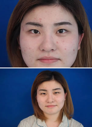 如何摆脱奶茶胖 直击小花在天津美莱死鱼眼+大饼脸蜕变全过程