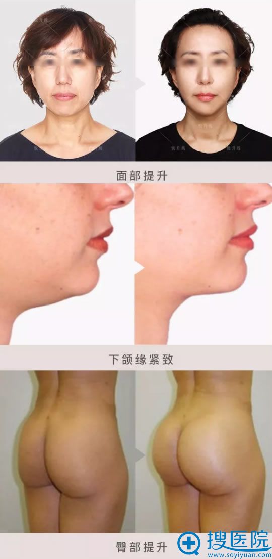 悦升线抗衰提升真人案例效果 悦升线抗衰提升真人案例效果