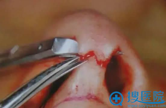 鼻尖发红示意图 鼻尖发红示意图