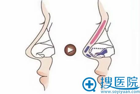 隆鼻假体雕刻的形状 隆鼻假体雕刻的形状