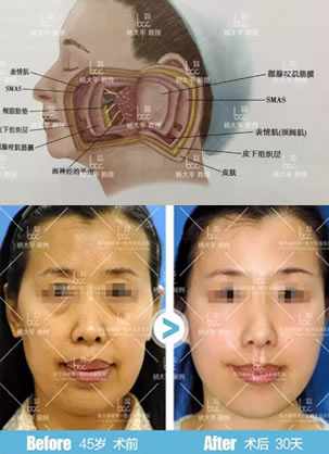 正确理解smas面部提升术让你避免掉入“拉皮”的误区