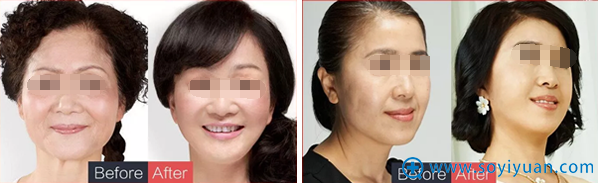 徐应胤线雕提升真人案例 徐应胤线雕提升真人案例