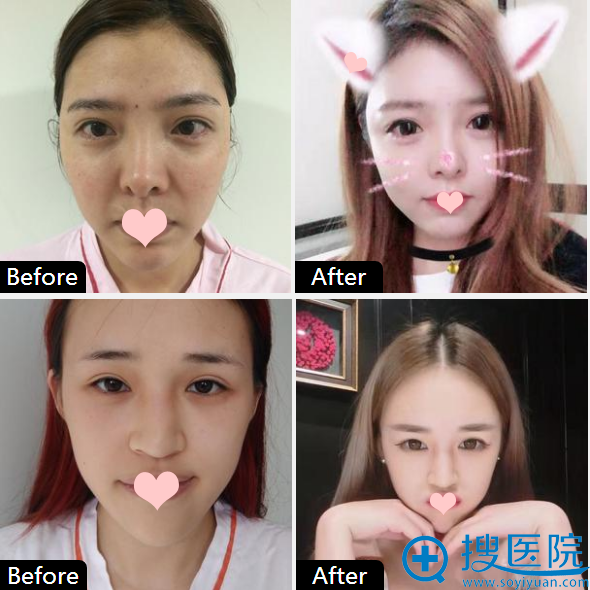 <!--<i data=20240710 data-id=14211></i>-->脂肪填充全脸案例对比图 <!--<i data=20240710 data-id=14211></i>-->脂肪填充全脸案例对比图