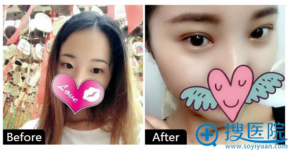 郑州集美刘德辉医生做的双眼皮案例 郑州集美刘德辉医生做的双眼皮案例