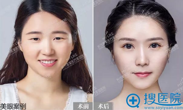 长沙美莱学生眼综合真人案例 长沙美莱学生眼综合真人案例
