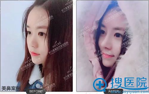 2018长沙美莱学生鼻整形案例 2018长沙美莱学生鼻整形案例