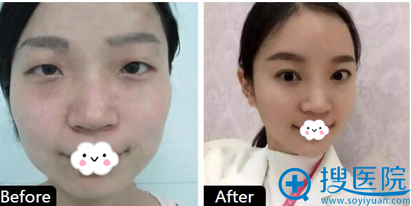 郑州集美赵亮做的自体脂肪填充案例对比图 郑州集美赵亮做的自体脂肪填充案例对比图
